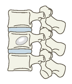 経皮的椎体形成術のイメージ
