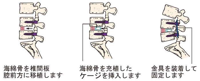 腰椎後方椎体間固定術