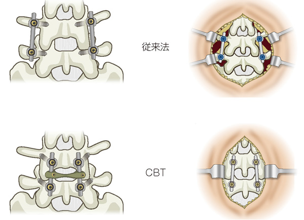 CBT（Cortical Bone Trajectory：皮質骨軌道）スクリュー法