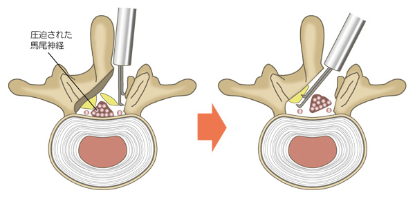 脊椎内視鏡下椎弓切除術（MEL）