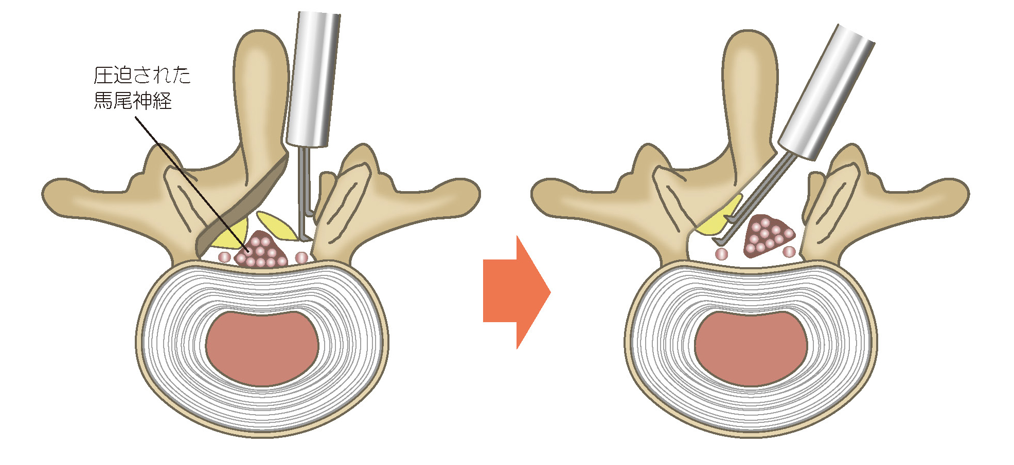 脊椎内視鏡下椎弓切除術（MEL）
