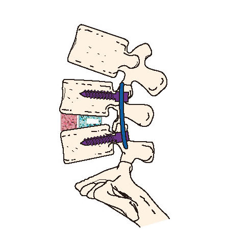 背骨を固定するインプラントのイメージ