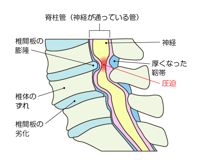 腰部脊柱管狭窄症