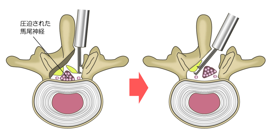 脊椎内視鏡下椎弓切除術(MEL)